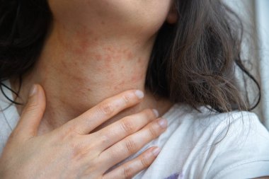 Kadının boynundaki yakın plan görüntülerde kızarıklık ve tahrişe bağlı alerjik deri reaksiyonu görülüyor. Egzama ya da atopik deri iltihabı olabilir. Dermatolojik referans için kapalı alanda yakalanmış.