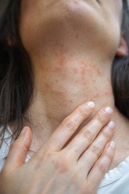 Kadının boynundaki yakın plan görüntülerde kızarıklık ve tahrişe bağlı alerjik deri reaksiyonu görülüyor. Egzama ya da atopik deri iltihabı olabilir. Dermatolojik referans için kapalı alanda yakalanmış.