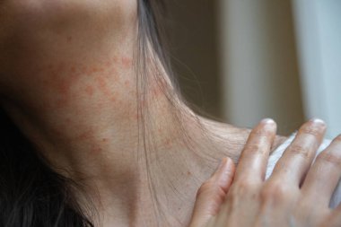 Kadının boynundaki yakın plan görüntülerde kızarıklık ve tahrişe bağlı alerjik deri reaksiyonu görülüyor. Egzama ya da atopik deri iltihabı olabilir. Dermatolojik referans için kapalı alanda yakalanmış.