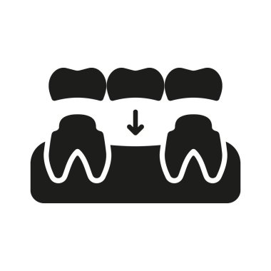 Dental Bridge Silhouette Icon. Tooth Regeneration. Porcelain Denture Glyph Pictogram. Partial Teeth Implant Restoration. Dental Treatment Solid Sign. Dentistry Symbol. Isolated Vector Illustration.