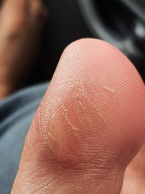 Nasır ya da hiperkeratoz, derinin tek bir bölgesindeki aşırı basınç ya da sürtünmeden kaynaklanır. Tekrarlanan stres ve sürtünmeye maruz kalan dokuyu güçlendirmek vücudun doğal tepkisidir..