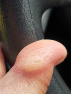 Nasır ya da hiperkeratoz, derinin tek bir bölgesindeki aşırı basınç ya da sürtünmeden kaynaklanır. Tekrarlanan stres ve sürtünmeye maruz kalan dokuyu güçlendirmek vücudun doğal tepkisidir..