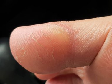 Nasır ya da hiperkeratoz, derinin tek bir bölgesindeki aşırı basınç ya da sürtünmeden kaynaklanır. Tekrarlanan stres ve sürtünmeye maruz kalan dokuyu güçlendirmek vücudun doğal tepkisidir..