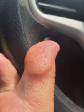 Nasır ya da hiperkeratoz, derinin tek bir bölgesindeki aşırı basınç ya da sürtünmeden kaynaklanır. Tekrarlanan stres ve sürtünmeye maruz kalan dokuyu güçlendirmek vücudun doğal tepkisidir..