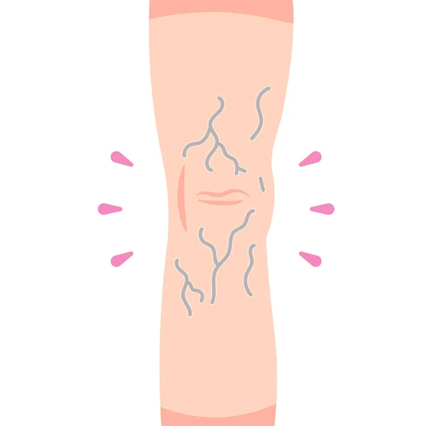 静脉曲张 膝后静脉的出现 血凝块健康问题 图例概念设计 — 图库矢量图片