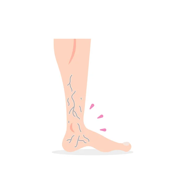 静脉曲张 腿上静脉的出现 血凝块健康问题 图例概念设计 — 图库矢量图片