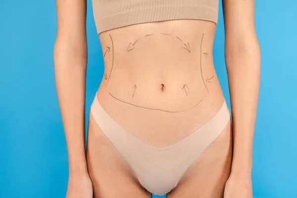 年轻女子的身体上有斑点线以矫正脂肪 被蓝色背景隔离了美容美发 抗衰老程序 整形外科概念 — 图库照片
