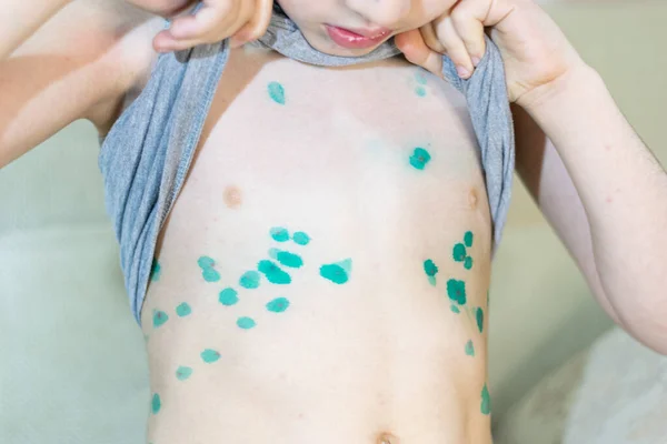 Child boy sick with chicken pox shows the bumps on his belly smeared with brilliant green