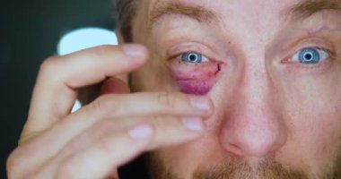 Saldırıdan sonra orta yaşlı bir adamın yakın çekim videosu. Aynaya bakar ve çürüğe dokunur. 4k görüntü.