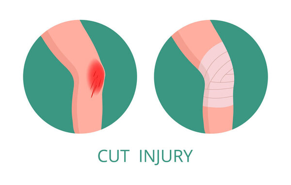 Knee injury medical treatment. Human body part first aid infographic, injured human leg first aid methods flat vector illustration. Cartoon medical bandaging