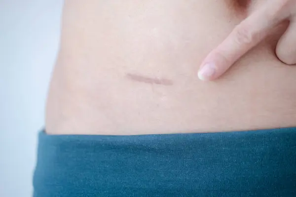 Close-up of scars after appendix surgery.