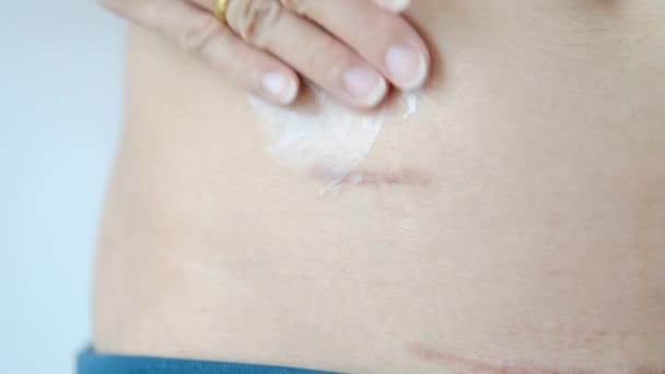Usando Creme Para Cuidar Cicatrizes Após Cirurgia Apêndice — Vídeo de Stock