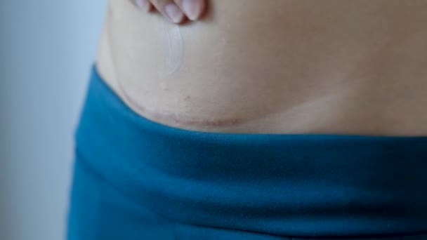Menggunakan Krim Untuk Merawat Luka Bedah Postpartum — Stok Video