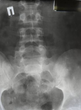 Belin alt kısmının parlak beyaz arka planına yakın plan röntgeni. Tıp makaleleri, dergiler, klinikler, çalışma rehberleri ve daha fazlası için