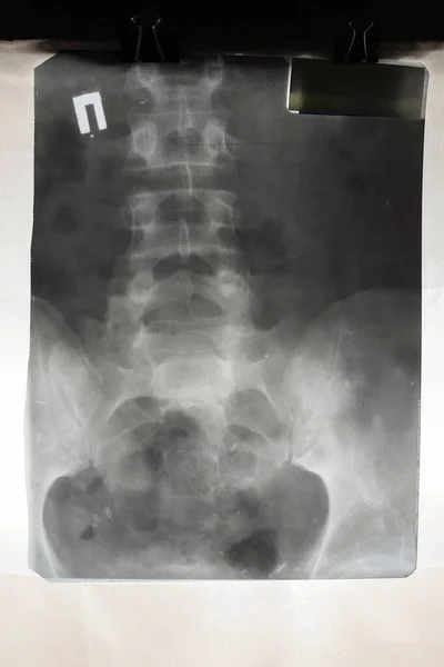 Close-up X-ray of the lower back against a bright white background. for medical articles, journals, clinics, study guides, and more