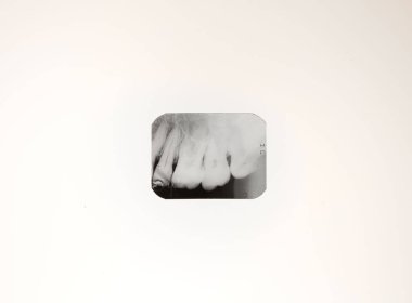 Close-up x-ray of human teeth against a bright white background. for medical articles, journals, clinics, tutorials and more clipart