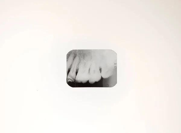 Detailní Rentgen Lidských Zubů Jasně Bílém Pozadí Pro Lékařské Články — Stock fotografie