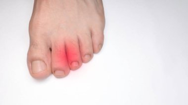 A Left foot toes of a person with a red mark representing pain clipart