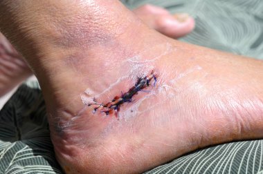 Ameliyat sonrası yara, dikişler, topuk kemiği kırığı.