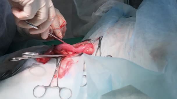 Handen Van Chirurg Voeren Een Complexe Chirurgische Operatie Uit Operatiekamer — Stockvideo