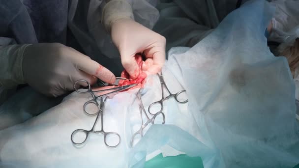 Ręce Chirurga Wykonują Skomplikowaną Operację Chirurgiczną Sali Operacyjnej Zbliżenie — Wideo stockowe