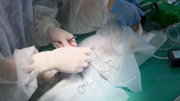 Ręce Chirurga Wykonują Skomplikowaną Operację Chirurgiczną Sali Operacyjnej Widok Bliska — Wideo stockowe