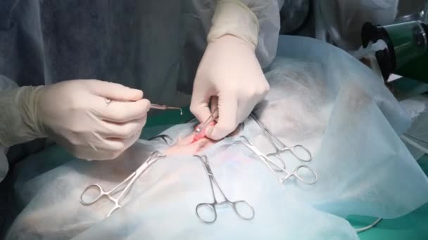 外科医の手は手術室で複雑な手術を行っている クローズアップ — ストック動画