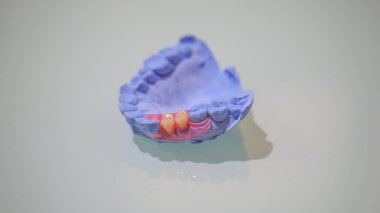 Çıkarılabilir takma dişlere takılmış bir diş modeli..