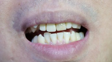 Gözle görülür diş sorunları ve renk bozulması olan, yanlış hizalanmış dişleri gösteren bir kişinin açık ağzının detaylı yakın plan görüntüsü. Görüntü diş bakımı ve ortodontik tedaviye duyulan ihtiyacı vurgular.