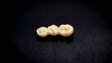 Siyah bir yüzey üzerinde diş köprüsünün yakın plan çekimi, diş protezlerinin diş nakli ve restorasyonu için kullanılması.