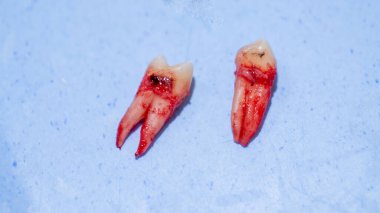 İki kökü ve alt azı dişi olan bir üst azı dişi ve yeni alınmış bir kök..