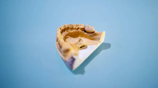 Mavi arka planda tek bir azı dişi zirkon kaplama dişlerini gösteren bir diş modeli, diş protezlerinin restorasyonunda kullanılan detayı ve yapısını vurguluyor.