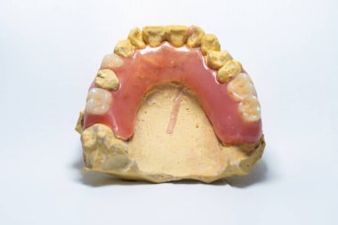 Kısmen çıkarılabilir takma dişler, sarı bir diş modeline takılan esnek malzemelerden yapılmış. Beyaz bir arkaplanda fotoğraflandı.