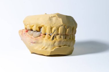 Diş taşı modelinde üst ve alt çeneler sıkılmış ve sağ alt popoya metal bir porselen protez takılmış. Beyaz bir arkaplanda fotoğraflandı.