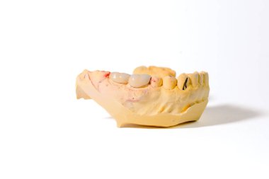 Diş taşı modeli alt çeneyi gösteriyor. Sağ arka tarafına porselen bir metal protez takılmış. Beyaz bir arkaplanda fotoğraflandı.