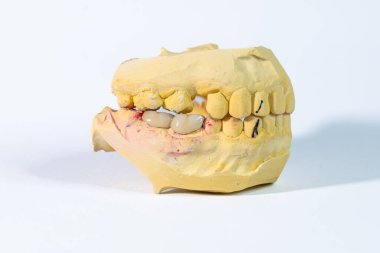 Diş taşı modelinde üst ve alt çeneler sıkılmış ve sağ alt popoya metal bir porselen protez takılmış. Beyaz bir arkaplanda fotoğraflandı.