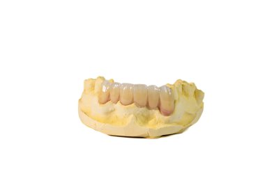 Diş taşı modeli üst çenede zirkon protezi olduğunu gösteriyor. Ön tarafta da protez var. Beyaz bir arkaplanda fotoğraflandı.