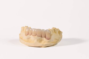 Diş taşı modeli üst çenede zirkon protezi olduğunu gösteriyor. Ön tarafta da protez var. Beyaz bir arkaplanda fotoğraflandı.