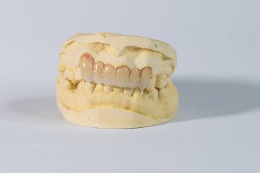 Diş taşı modeli üst ve alt çenelerin sıkıldığını ve üst ön çeneye zirkon protezi takılı olduğunu gösteriyor. Beyaz bir arkaplanda fotoğraflandı.