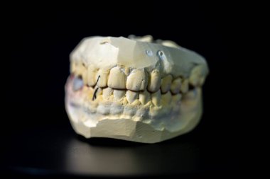 Diş taşı modelinde üst ve alt çeneler sıkılmış ve sağ alt popoya metal bir porselen protez takılmış. Siyah bir arkaplanda fotoğraflandı.