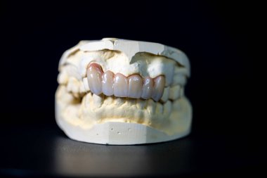Diş taşı modeli üst ve alt çenelerin sıkıldığını ve üst ön çeneye zirkon protezi takılı olduğunu gösteriyor. Siyah bir arkaplanda fotoğraflandı.
