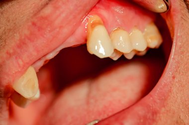 Dişlerinin nerede eksik olduğunu gösteren bir hasta. Üst çene ön kısmı da dahil..