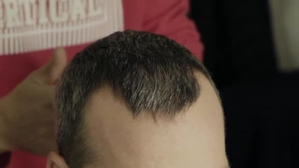 Man Bald Spots Suffering Hair Loss Hair Problem Treatment Close — Vídeo de stock