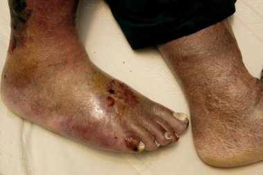 Ganimet ülseri. Bacaklarda kötü yaralar var. Varis yaralarının tedavisi.