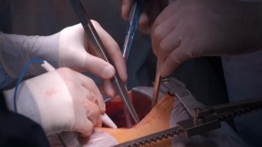 Cerrahi odasındaki açık kalp ameliyatı sırasında bir hastayı ameliyat eden profesyonel doktorların yakınlaşması. Sağlık ve tıbbi müdahale kavramı.