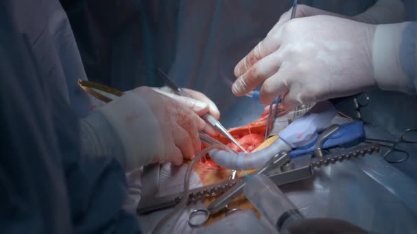 手術室で開かれた心臓手術を行う患者を運営する専門医チーム 医療介入の概念 — ストック動画