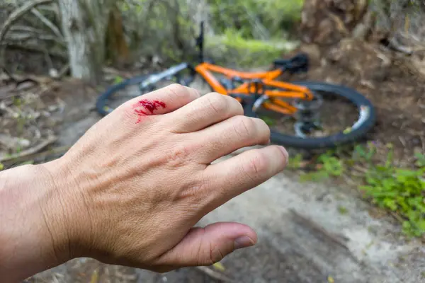 Mountain bike accident. Rider hand wound with red blood from hitting a tree stump.