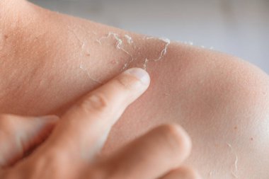 Cildinde güneş yanığı. Güneş yanığından sonra deri dökülmesi. Güneşe dokunan adam omuzlarında bir elle soyulmuş deriye zarar verdi. Derisi soyuluyor, yanmış deri. Cilt bakımı kavramı