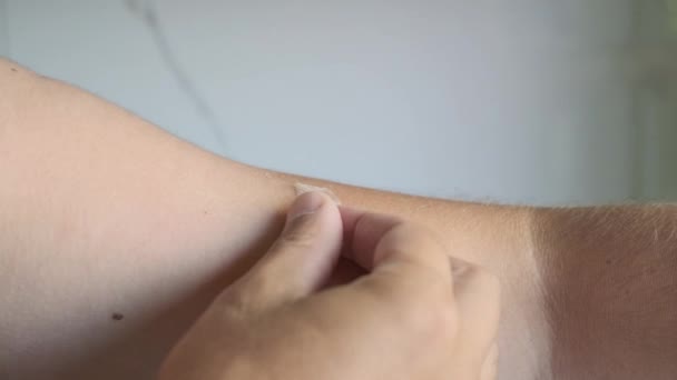 Exfoliation Skin Sunburn Man Peeling Skin His Arm Skin Peels — Stock Video