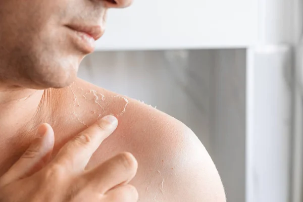 Sunburn on the skin. Exfoliation of the skin after sunburn. Man touching sun damaged peeling skin with a hand on the shoulders. Burnt skin. Skincare concept